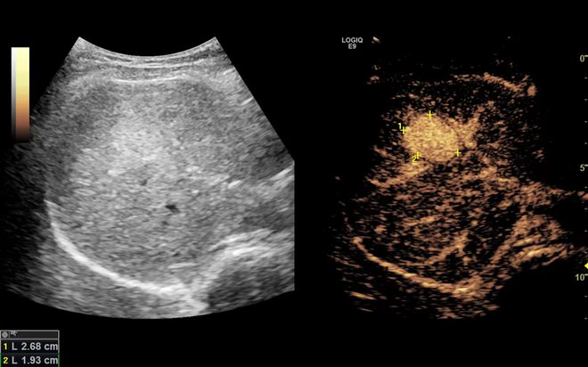 安博体育：超声造影：小小微泡大大作用！(图3)